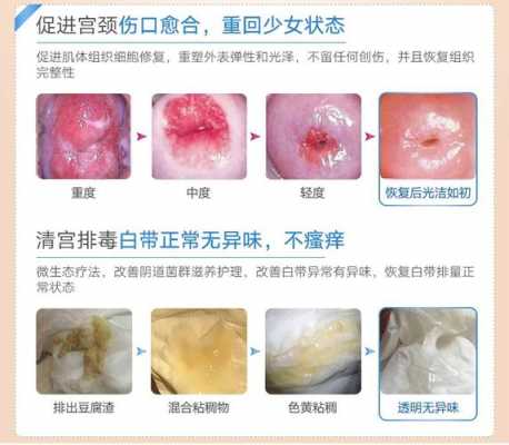 宫颈粘连用凝胶有用没（宫颈粘连上药有效果吗）