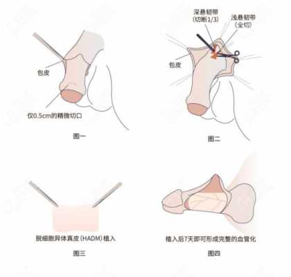 包皮延长术有用吗（包茎延长）