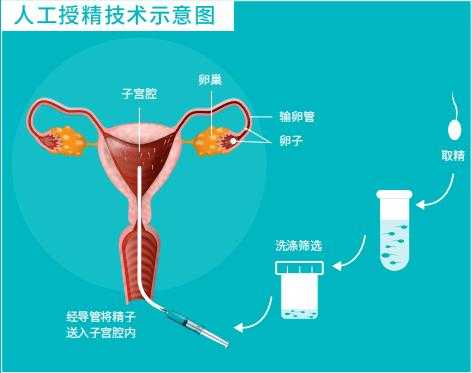 少精做人工授精有用吗（少精做人工受精有用吗）