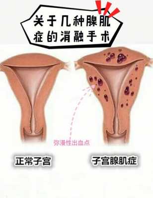 腺肌症做介入有用吗（腺肌症介入手术治疗效果如何）