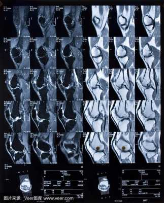 膝关节核磁共振有用吗（膝关节核磁共振准确吗）
