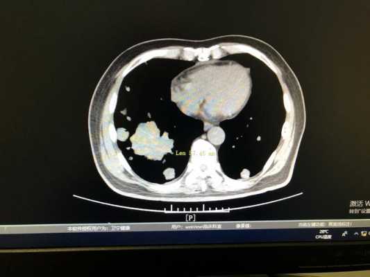 肺部转移肝化疗有用（肺癌肝转移化疗后病灶能消失吗?）